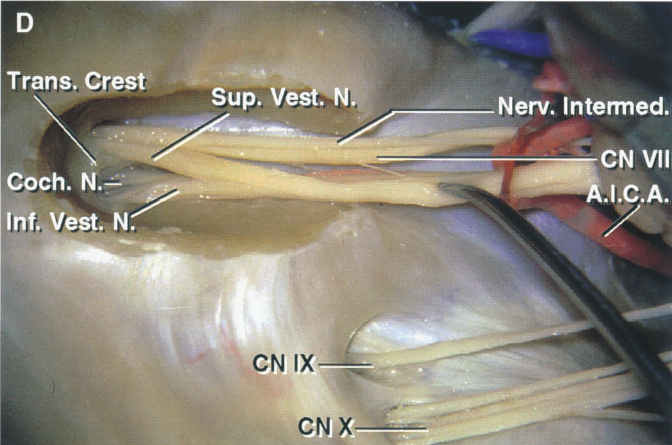 TranEqest Sup. VesC.NJÅ Coch. N.=• lhf. Vest. N. CN IX Nerv. Intemed. CN Vil .I.C.A. 