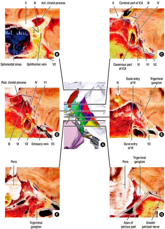 Ill Ant. clinoid process Cerebral part of ICA Cavernous part VI of ICA Dural entry Trigeminal Pons ganglion Ill Sphenoidal sinus Post. clinoid process V2 IV Trigeminal ganglion Ophthalmic vein Trigeminal ganglion Apex of petrous pat Greater petrosal nerve 
