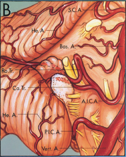 Anterolateral view of the right cerebellopontine angle