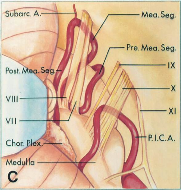 u arc. A. Post. VIII VII Chor. Med Mea. Seg. Pre. Mea. Seg. IX x XI P. I.C.A. 