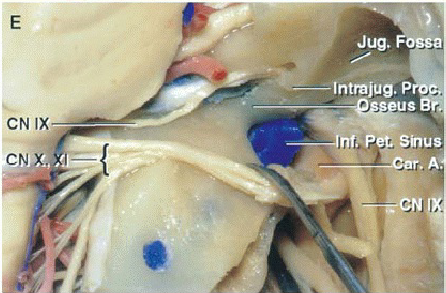 The nerves entering the jugular foramen have been displaced downward. 