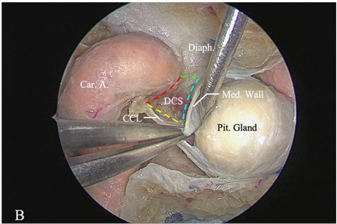 Car.'*:::- Med: wall' OCS Pit. Gland 