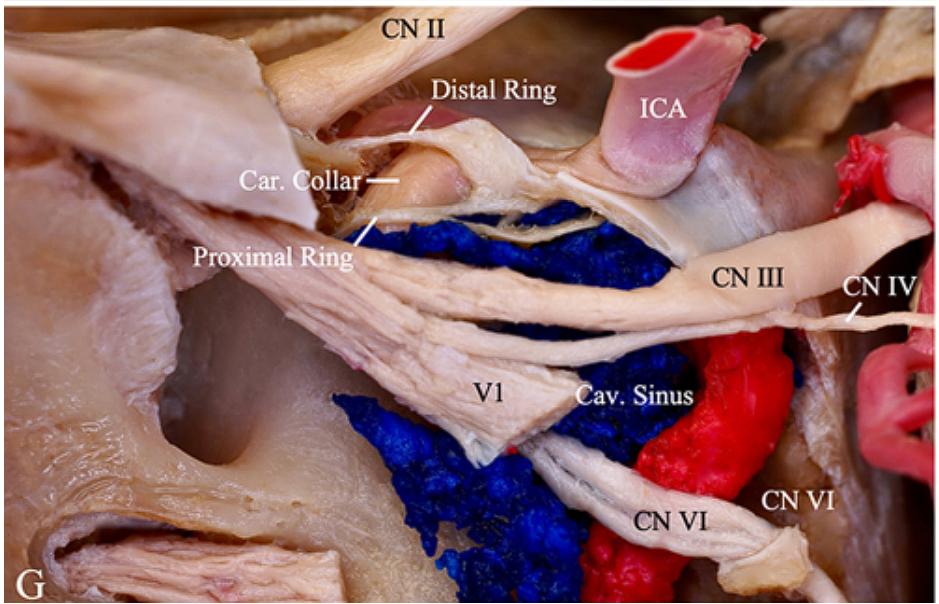 CN 11 Distal Ring ar. llar' ICA CN 111 av. Sinus 