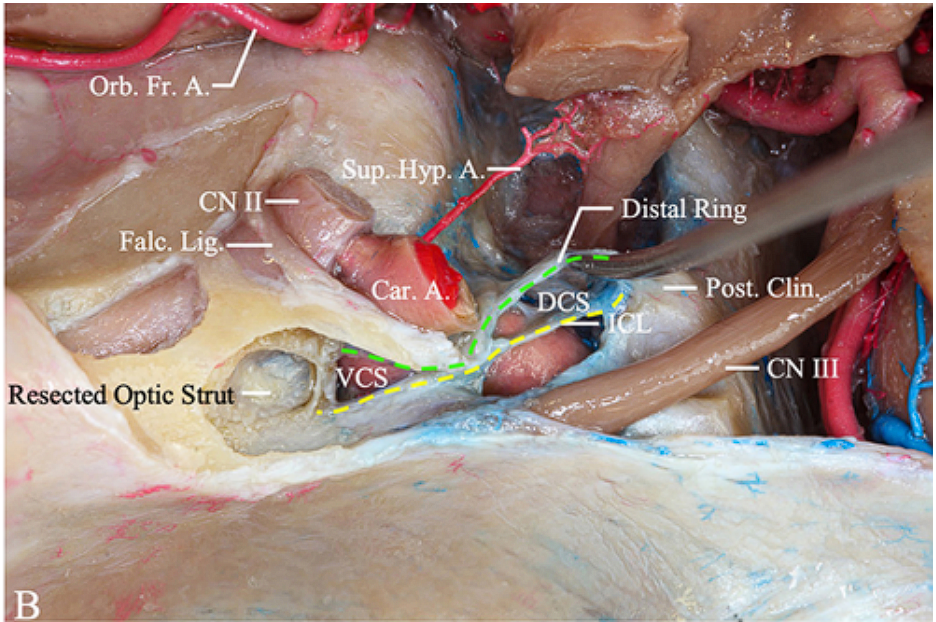 Orb. Fr. A. A. Falc. Lis Resected Optic Strut Ring Post. cr vcs 