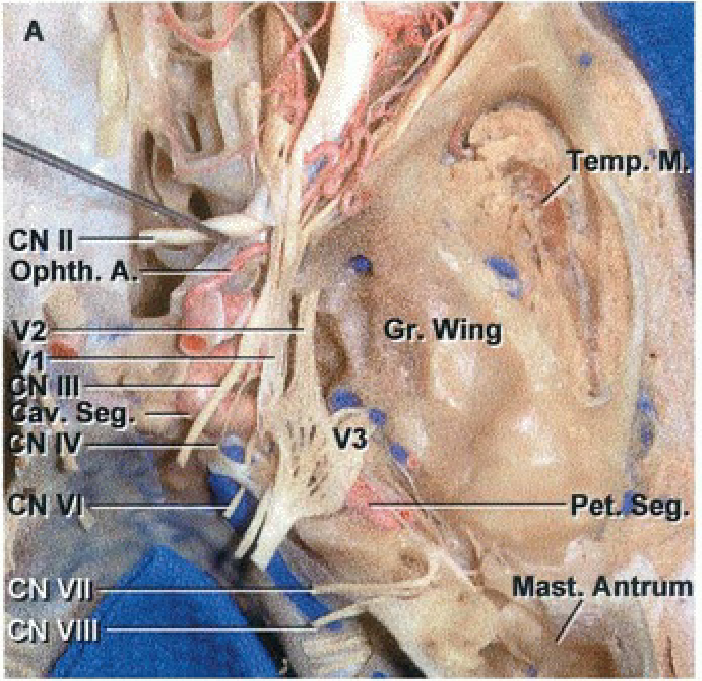 CN 11 Ophth. A. CN mp.s Gr, Wing Pet-Seg Mast. Antrüm 