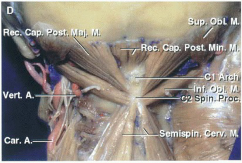 Vert. A. sup. Obi M. Rec. cap. Post. Mi . Cl Semispin. 