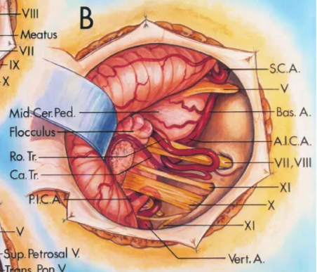 Cer Pon Fiss. Mid.Cer Pee. flocculus Porn. M Cho r. Cerfbn Fi V. of R)n. V.of Mid.Cer VSE C Lai Med. r ped. Carr V ns. pon.V V of Cer. .ic.A. sc.A. AICA. VII,VIII Wrt.A. S.C.A. sal V Vert A, 