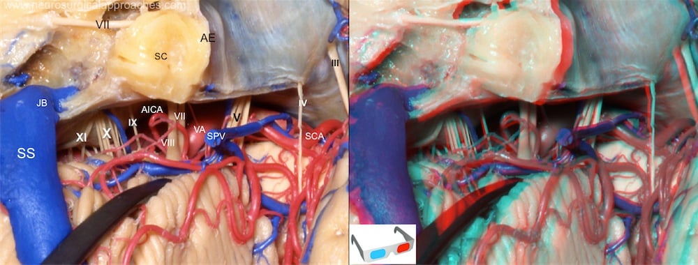 Left side: AE: arcuate eminence; AICA: anteroinferior cerebellar artery; JB: jugular bulb; SC: semicircular canals; SCA: superior cerebellar artery; SPV: superior petrosal vein; SS: sigmoid sinus; VA: vertebral artery.