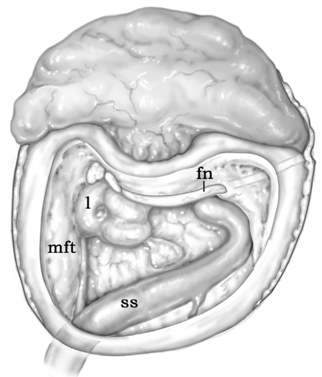 Skeletonization of the mastoid (fn, facial nerve; ss, sigmoid sinus; l, labyrinth; mft, middle fossa tegmen).
