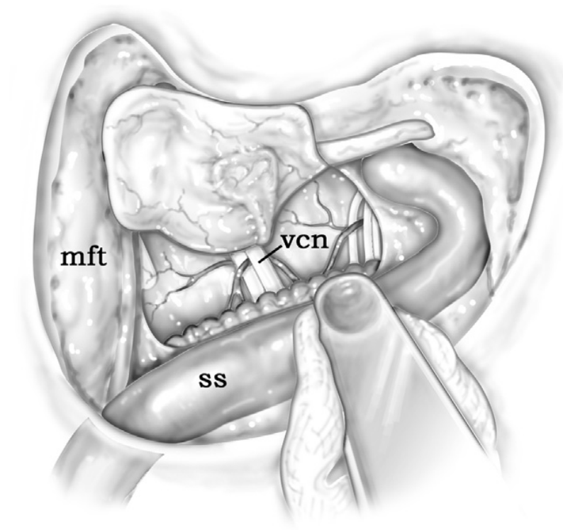 Exposure following raising of anterior base dura flap, with retractor in place posteriorly to aid exposure (ss, sigmoid sinus; mft, middle fossa tegmen; vcn, vestibulocohlear nerve).