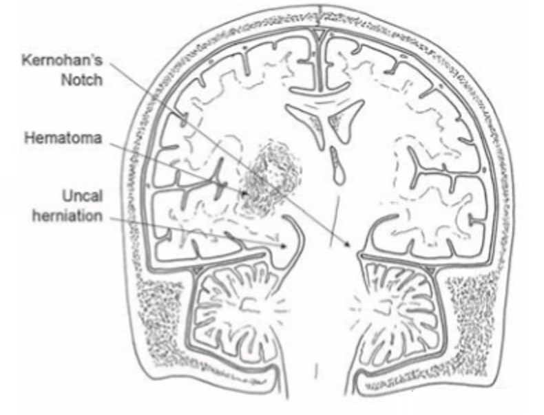 Artist’s rendering of uncal herniation