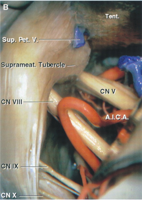 Tent. sup. Pet V. Suprameat. Tubercle CN V CN VIII 