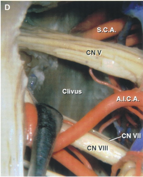 S.C.A. CN.v Clivus CN VIII A.I.C.A. CN VII 