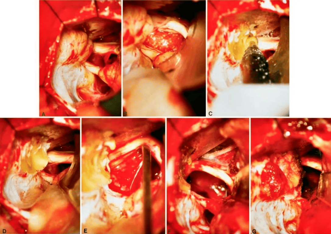 FIG. 3. Intraoperative photographs obtained in the patient represented in Fig. 1, demonstrating tumor exposure and re- section via a retrosigmoid craniotomy performed with the patient in a semisitting position. A: View of the left CPA with the fifth, seventh, eighth, ninth, and 10th cranial nerves exposed. The tumor is located between the fifth nerve and the seventh—eighth nerve complex. B: Higher magnification of the view presented in A, showing the tumor between the fifth cranial nerve and the seventh—eighth nerve complex. C: The suprameatal bone is being drilled away. D: Par- tial resection of the suprameatal bone. E: The trigeminal nerve is mobilized upward to allow additional tumor exposure and resection. F: Complete tumor resection is performed by opening Meckel's cave, and the surrounding nerves are preserved. G: The drilled bone area is covered with muscle and fibrin glue. 