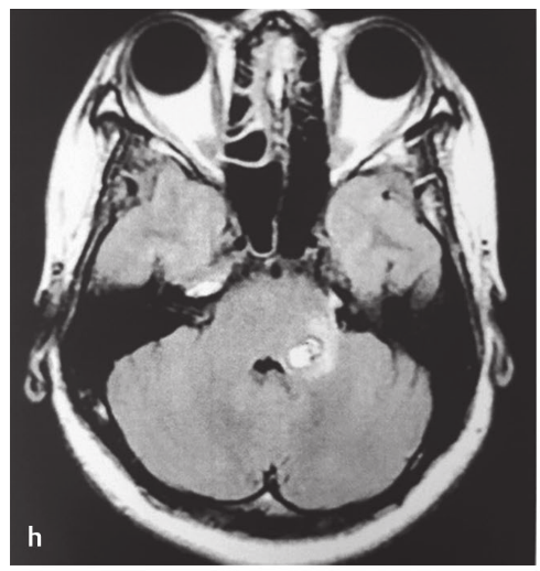 A close-up of a brain scan AI-generated content may be incorrect.