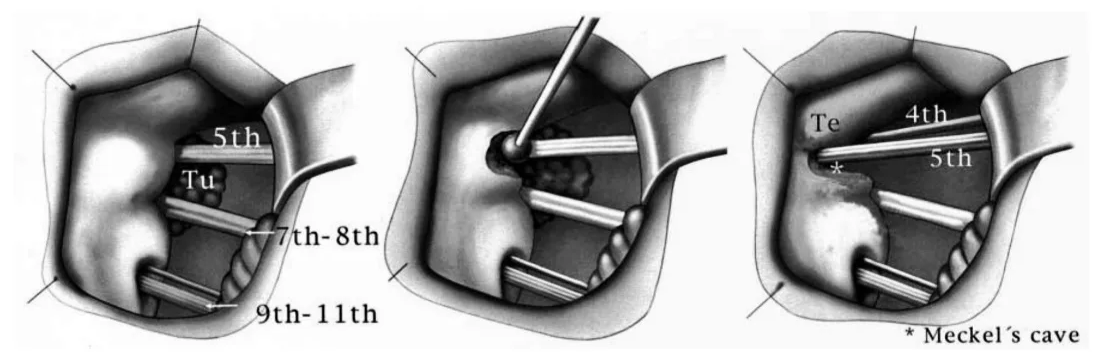 eckel's cave FIG. 1. Schematic drawings showing the procedure by which the suprameatal bone is drilled during the RISA. Surgery is performed with the patient in a semisitting position, and the cerebellum is retracted medially. The nerves running in the CPA are shown. The tumor (Tu) is exposed in the CPA and followed through Meckel's cave, which is opened by drilling the suprameatal bone. Finally, the portion of the tumor within Meckel's cave is resected. If necessary, the tento- rium (Te) can be opened above the fifth cranial nerve, which can be mobilized, thus improving access to the middle fossa. Ordinal numbers indicate cranial nerves. 