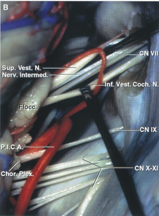 Sup. Vest. N. Nerv. Intermed. Iocc. Chor—. CN IX CN x-Xl 