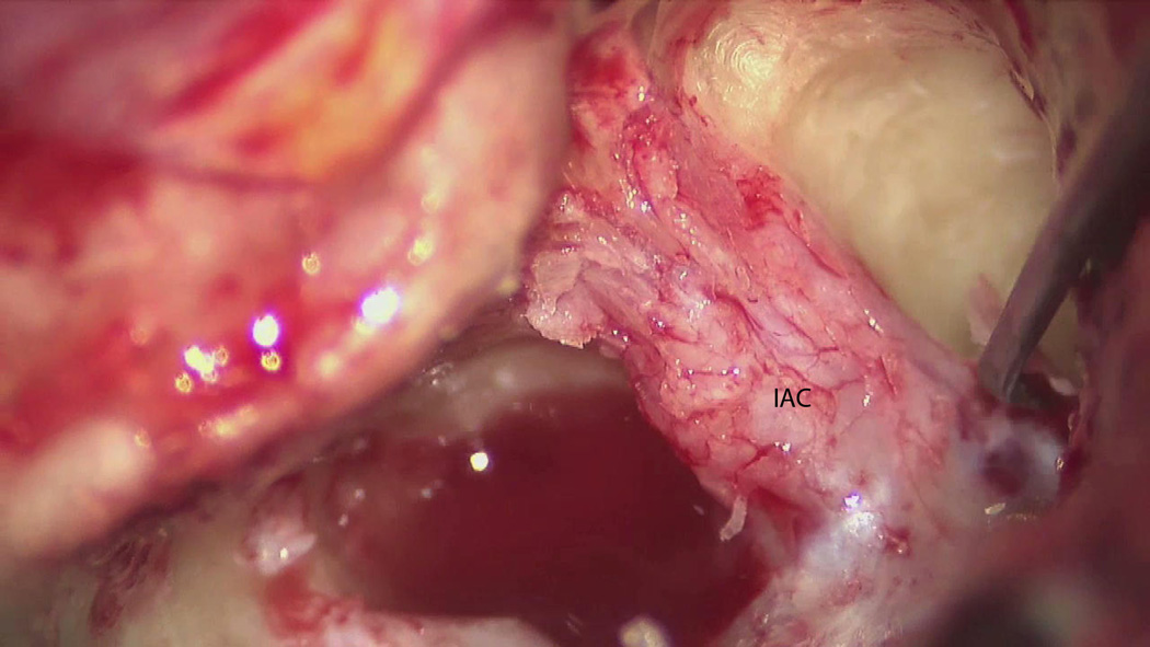 Microscope still photo showing the dura of the internal auditory canal exposed with troughs drilled superiorly and inferiorly. IAC = internal auditory canal.