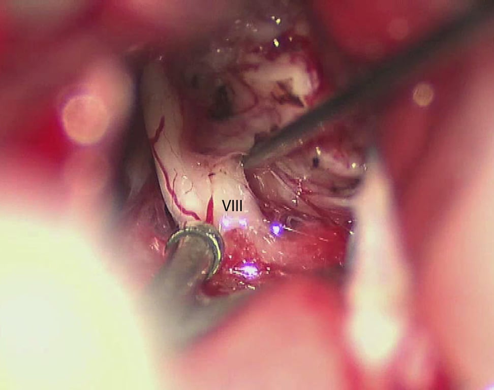Microscope still photo. Cranial nerve eight identified along the posterior edge of the tumor at its entry zone along the brainstem. VIII = cranial nerve eight.