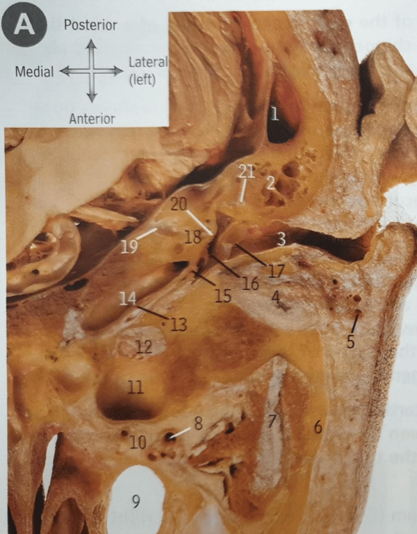 An axial cut through the Left petrous bone