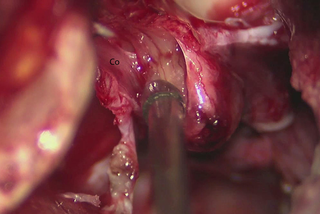 Microscope still photo showing a small remnant of tumor adherent to the facial nerve, which is not well visualized. At this stage in the resection, the cochlear nerve is about to be divided in the IAC. Co = cochlear nerve.