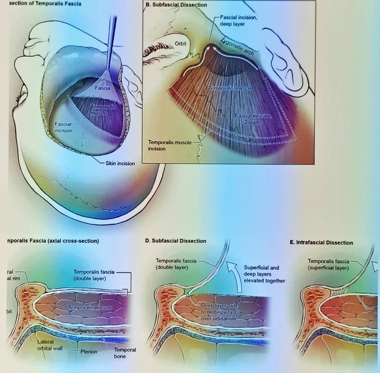 section of Temporalis Fascia Fascia emporallG muscle, Fascial incision Skin incision nporalis Fascia (axial cross-section) B. Subfascial.Dissection Orbit Temporalis muscle incision D. Subfascial Dissection Temporalis fascia (double layer) Fascial incisim. deep layer Temporål' muscle " , asctal•inc'siÖn. 2Jayers. Superficial and deep layers elevated together E. Intrafascial Dissection Temporalis fascia (superficial layer) ral al rim bit Temporalis fascia (double layer) Temporal bone tomObilizegfascia over orbital rim NLateraI o ital wall 