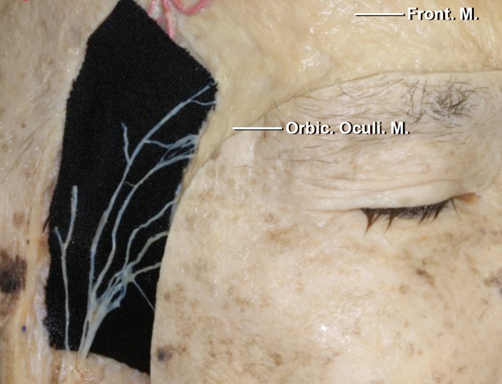 Figure 3: The locations of the frontalis branches of the facial nerve through the fat pad are demonstrated. These branches should be protected through the use of single layer myocutaneous flaps as well as interfascial and subfascial dissection through the fat pad. These maneuvers avoid postoperative frontalis palsy. Please see more informaton below in the additional considerations section regarding the interfascial and subfascial techniques for preservation of the frontalis branch. For more anatomical information related to the keyhole, please refer to the Orbitozygomatic Craniotomy chapter.