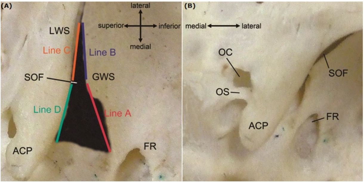 A) LWS Line C' SOF Line D i ACP superior medial Line B GWS _ ine A inferi (B) oc SOF os— ACP 