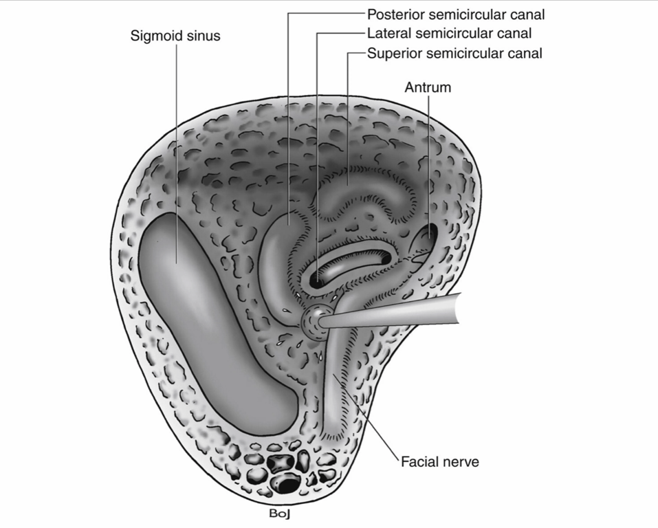 The facial nerve and the sigmoid sinus have been skeletonized. The lateral semicircular canal is opened. 