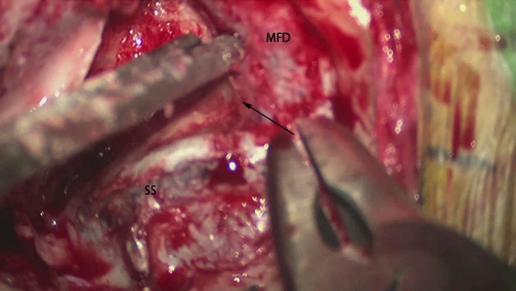 Microscope still photo illustrating the dural exposure partway through the temporal bone drilling. SS = sigmoid sinus, MFD = middle fossa dura, Arrow demonstrates the direction of the superior petrosal sinus along the petrous ridge.