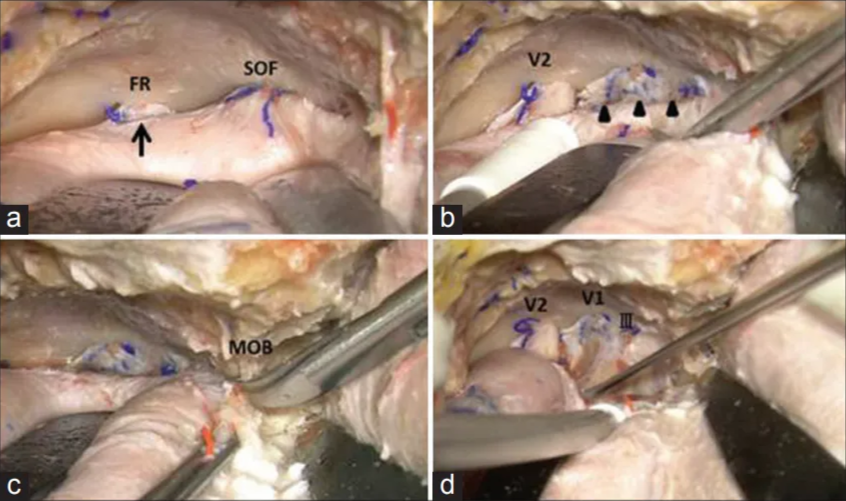Figure I: After standard frontotemporal craniotomy, the middle fossa dura is dissected until the foramen rotundum, and superior orbital fissure are exposed (a). Skeletonization of the foramen rotundum is not needed because this junction is naturally exposed at the foramen rotundum (a, arrow). The roof of the superior orbital fissure is skeletonized and opened to expose the junction between the dura propria of the temporal lobe and the periosteal dura (b, arrowheads). The bone around the meningo-orbital band is drilled and incised to a length of 4 mm (c). Peeling of the dura propria is started from the foramen rotundum to the lateral wall of the superior orbital fissure (d). V2: Second division of the trigeminal nerve 