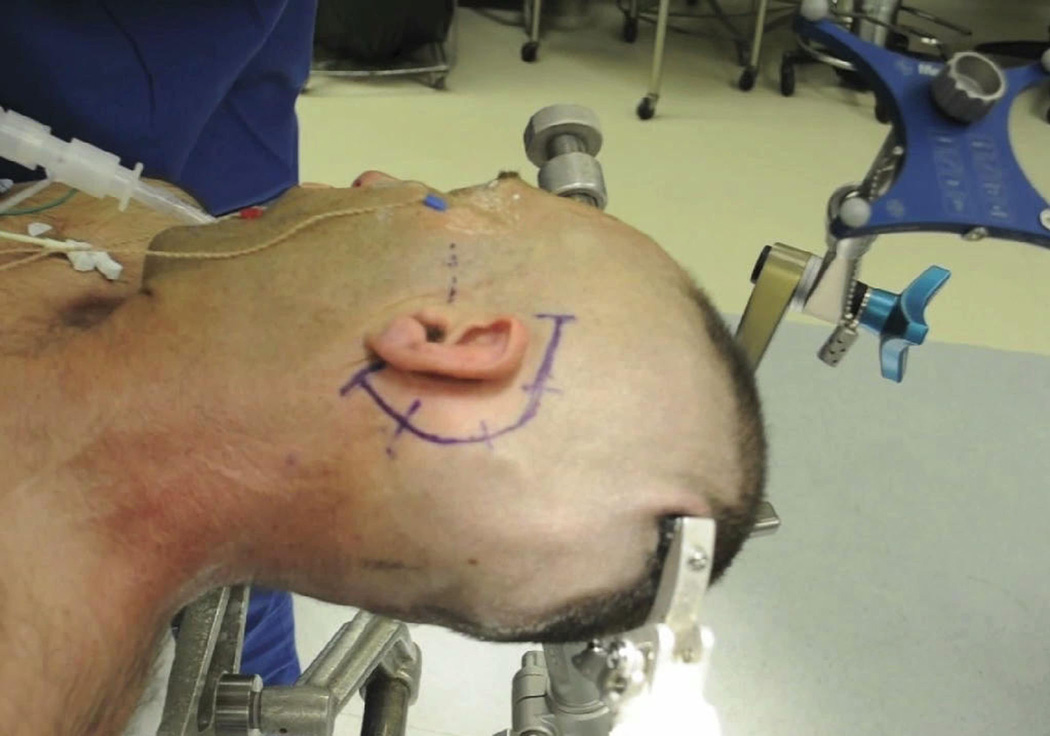 Photograph depicting the patient’s head positioned and secured in pins with EMG needles in place and a navigational frame attached. The zygomatic arch and planned incision are marked.