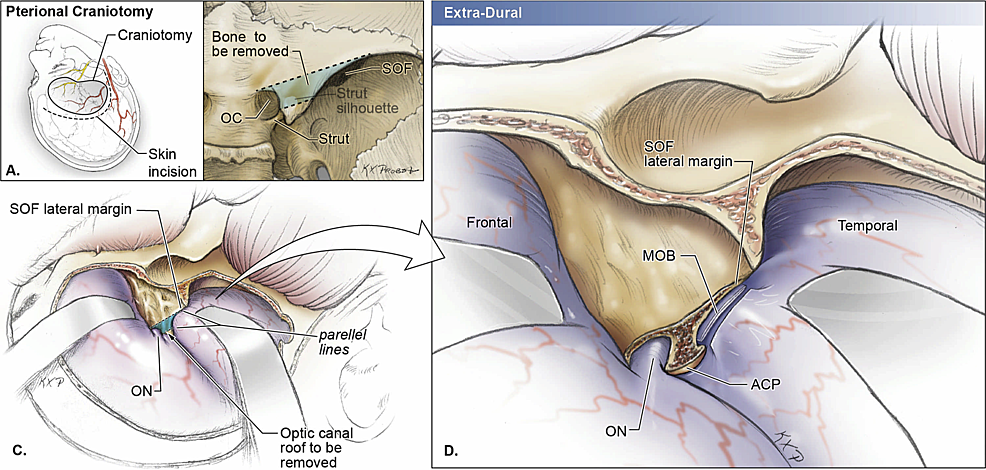 Schematic-drawings-of-a-right-pterional-approach-with-extra-dural-removal-of-the-anterior-clinoid-process-