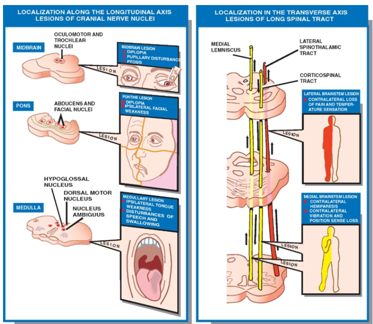 LOCALIZATION ALONG THE AXIS LESIONS OF CRANIAL NERVE NucLE1 Nuct_ E us LOCALIZATION IN 'HE TRANSVERSE AXIS LESIONS OF LONG SPINAL TRACT 