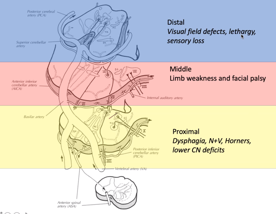 Distal Visual field defects, lethargy, sensory loss Middle Limb weakness and facial palsy Proximal Dysphagia, N+V, Homers, lower CN deficits 
