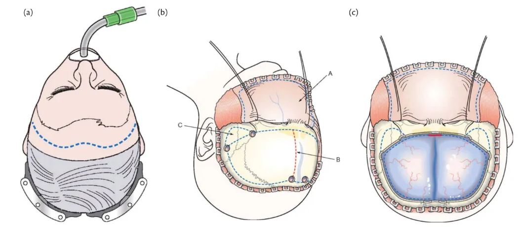 Bifrontal decompressive craniectomy. (A) The dotted line represents the usual skin incision for bifrontal decompressive craniectomy, which should be kept behind the hairline. (B) A bicoronal myocutaneous flap is reflected anteriorly. The dotted line on the skull represents the usual extent of the craniectomy. Subtemporal decompression is optional. (C) The bone flap has been removed. The dotted line on the dura mater represents our preferred method for opening the dura. The dura is opened on either side of the midline in a C-shaped fashion with its base along the superior sagittal sinus. Division of the superior sagittal sinus anteriorly and of the falx (red line) is optional.