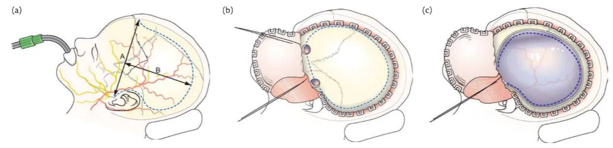 Unilateral decompressive craniectomy. (A) The dotted line represents the usual skin incision made during unilateral decompressive craniectomy. To preserve adequate vascular supply, the length of the incision (distance B) should not exceed its width (distance A). (B) A myocutaneous flap is reflected. The dotted line represents the usual extent of the craniectomy. (C) The dotted line on the dura mater represents our preferred method for opening the dura. The dura is opened in a C-shaped fashion with its base along the sphenoid ridge. The dural incision is kept 5–10 mm away from the craniectomy edges to minimize the risk of injury to the protruding brain.