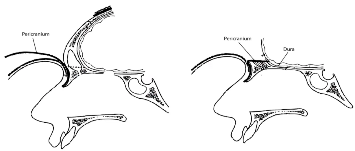 Cranialisation and occlusion of the frontal sinus 