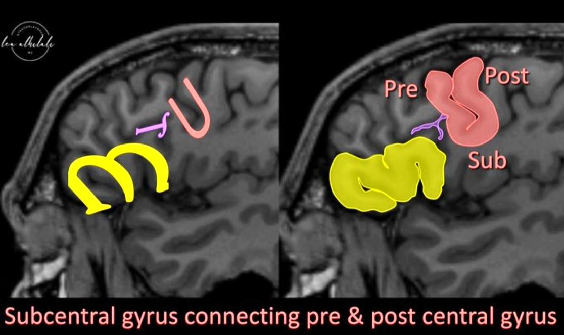 Subcentral gyrus connecting pre & post central gyrus 