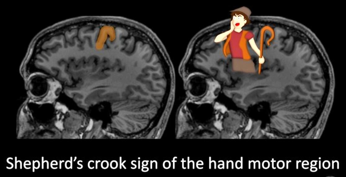 Shepherd's crook sign of the hand motor region 
