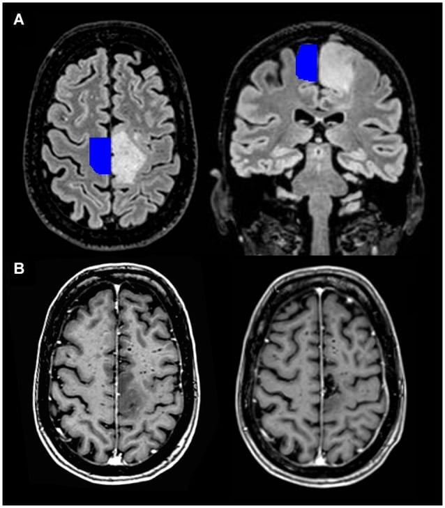 A close-up of a brain scan AI-generated content may be incorrect.