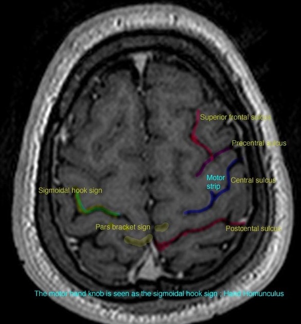 A close-up of a brain scan AI-generated content may be incorrect.