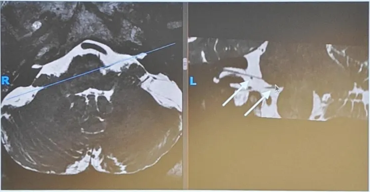 MRI of patient with left HS, reported as “negative” for neurovascular conflict