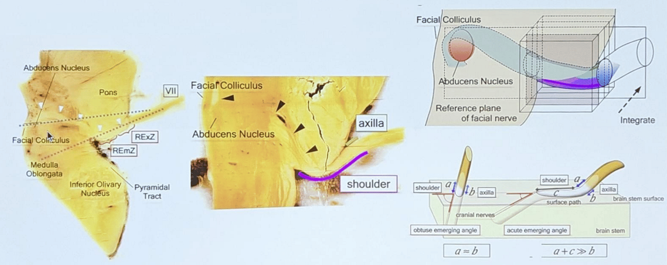 Surgical anatomy of the VIIth nerve root exit zone