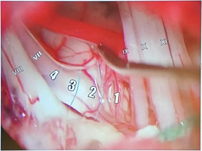 Surgical anatomy of the VIIth nerve. Entire nerve decompression is necessary in HFS! See Zhong 2010