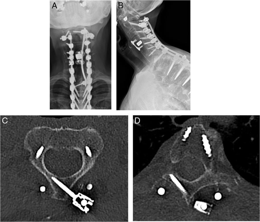 A 75-year-old woman who underwent T2 pedicle subtraction osteotomy for cervicothoracic kyphosis. Because of osteoporosis, a third rod fixation was applied with 3-point fixation of C2 and T3 to provide additional posterior tension band. Postoperative (A) anteroposterior and (B) lateral cervical spine radiographs showing a left C2 translaminar and left T3 translaminar screw with a third rod across the T2 pedicle subtraction osteotomy site. Axial CT images showing placement of left (C) C2 and (D) T3 translaminar screws.
