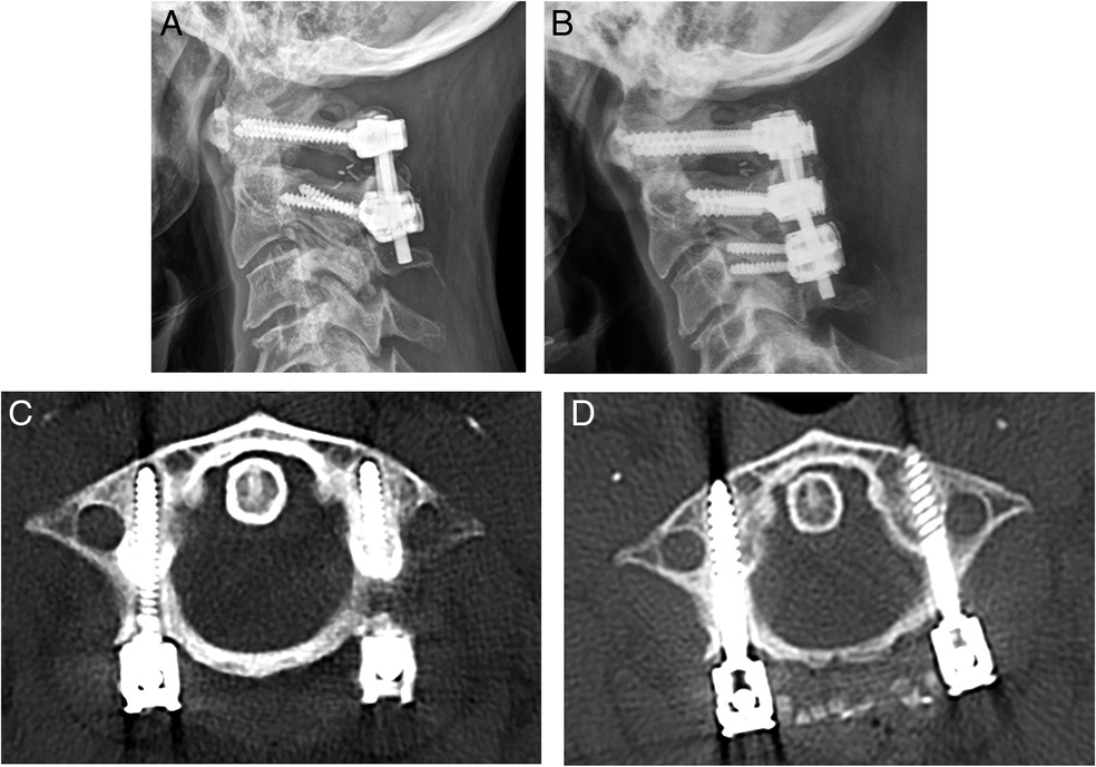 A 47-year-old woman with nonunion of posterior C1/C2 instrumented fusion with screw loosening. 
(A) Lateral cervical spine radiograph shows haloing across the C1/C2 screws, indicating instrumentation loosening. 
(B) Axial CT at C1 confirms haloing of the C1 screws bilaterally. 
(C) Lateral cervical spine radiograph shows placement of larger screws with additional fixation at C3. 
(D) Axial CT shows large-diameter C1 screws with bone graft across the C1 ring.