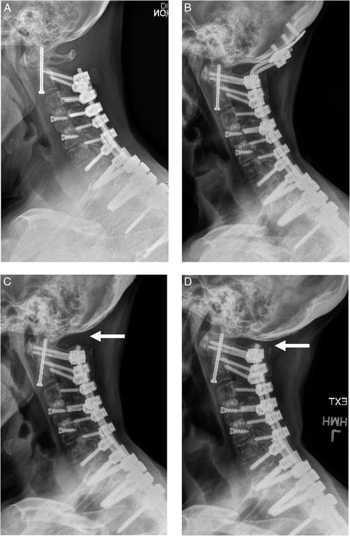(A) Lateral cervical spine radiograph of a 64-year-old woman who presented with a dens fracture nonunion after anterior odontoid screw fixation. (B) Because of the extensive cervicothoracic fusion construct, posterior fixation to the occiput without fusion (occipital tethering) was performed with a posterior C1/2 fusion. Radiographs taken 14 months after the occipital tethering surgery showing the patient in (C) flexion and (D) extension after removal of the occipital plate. She gained 23 degrees of occiput-C1 segmentation (arrows) after plate removal.
