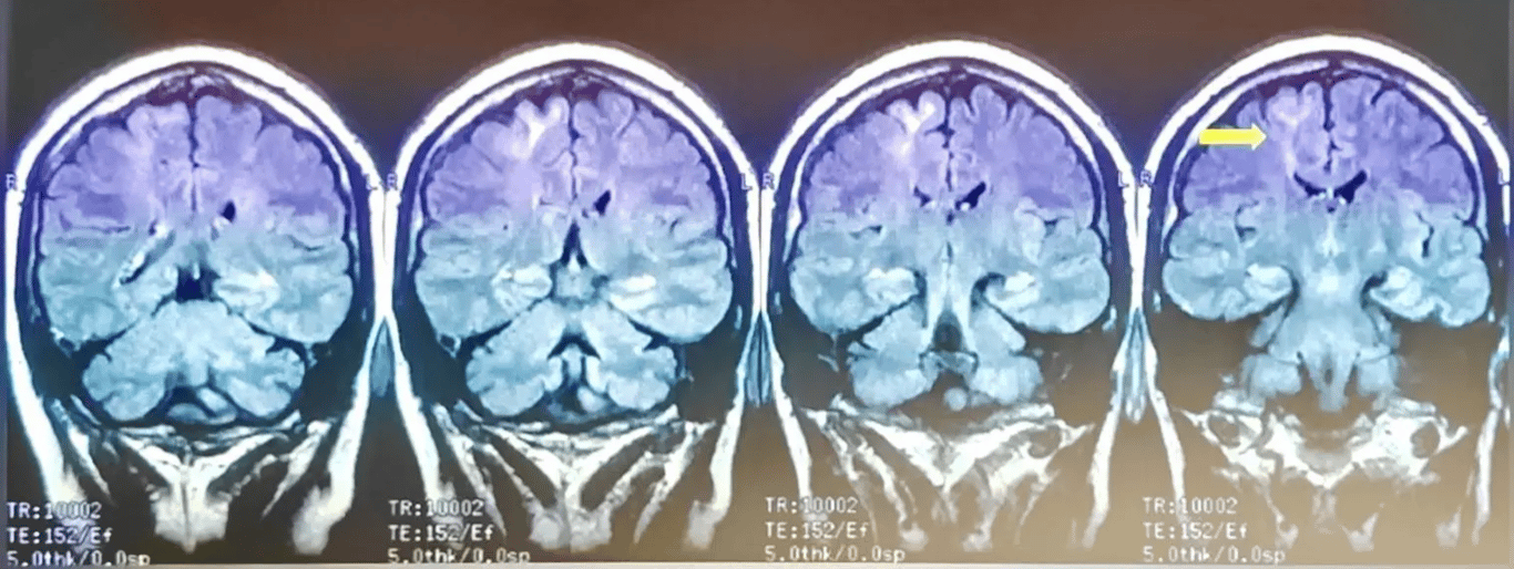 Review the images in the context of seizure semiology and EEG findings