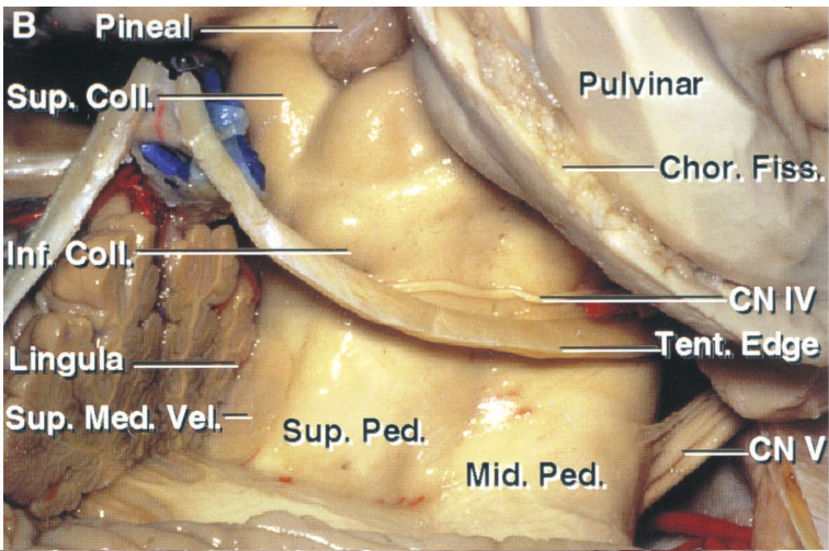 Sup. inguiå sup. Med. Vel.= . . Mid. Ped Pulvinar sup. Ped. Chor. Fi N IV ent. NV 